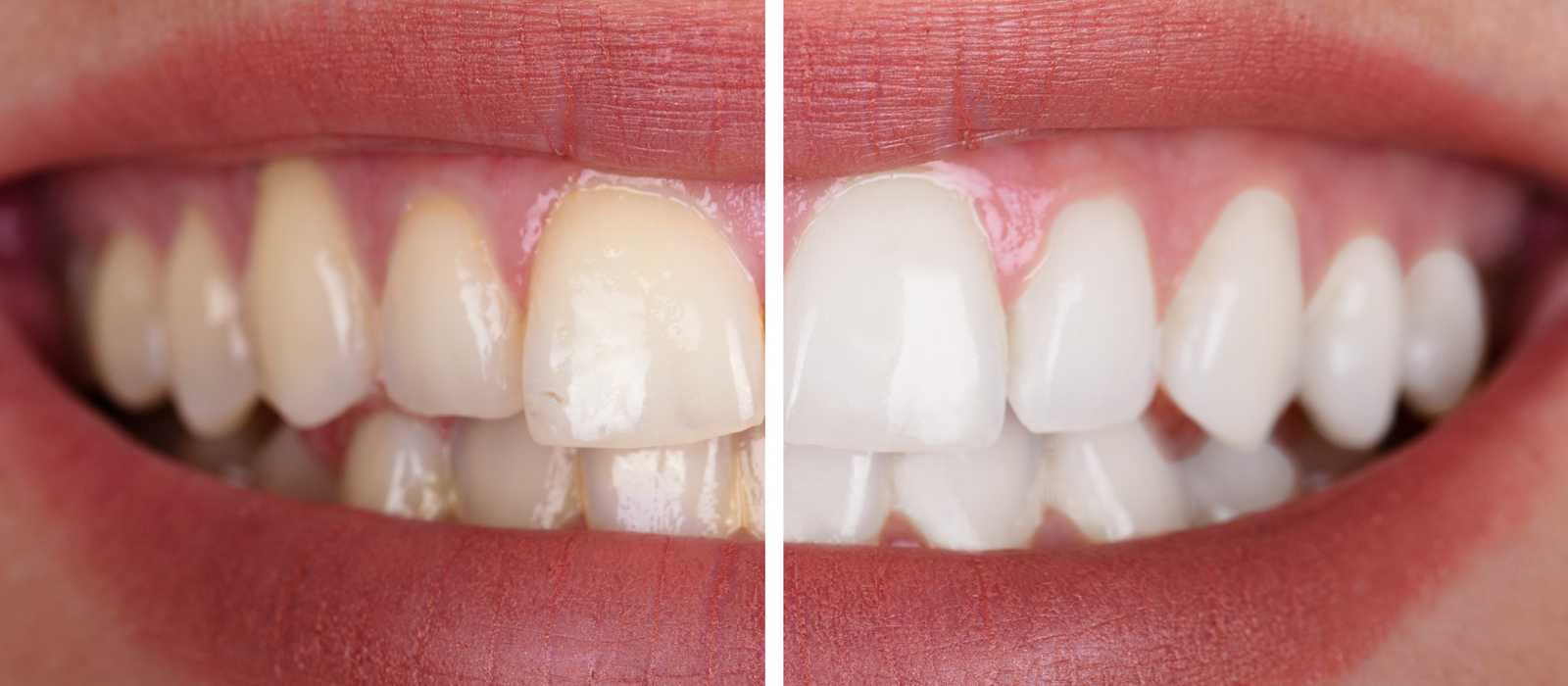 Mulher sorrindo após clareamento dental profissional em Alphaville.