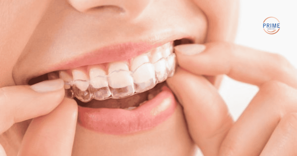 Paciente sorrindo ao colocar o aparelho invisível Invisalign, demonstrando conforto e estética durante o tratamento.