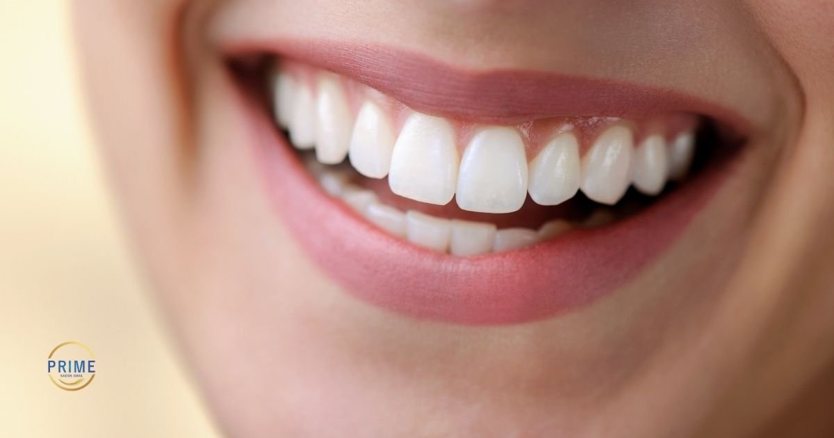 Close de um sorriso branco com lentes de contato dentais perfeitas ilustrando se o material mancha com o tempo.