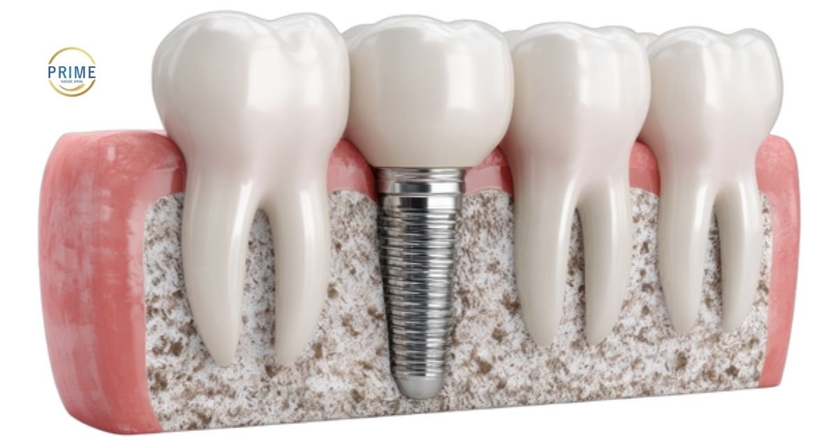 Ilustração em corte lateral de um implante dentário posicionado entre dentes naturais, mostrando o pino de titânio fixado ao osso maxilar e a coroa protética visível acima da gengiva.