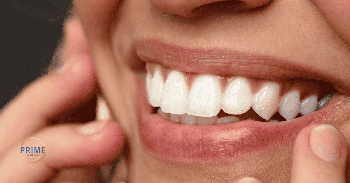 Mulher jovem com sorriso perfeito após procedimento de lentes de contato dental em Alphaville na clínica Prime Saúde Oral.