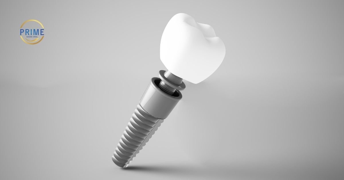 Diagrama técnico de um implante dentário Prime Saúde Oral evidenciando o pino de titânio, o pilar de conexão e a coroa protética.