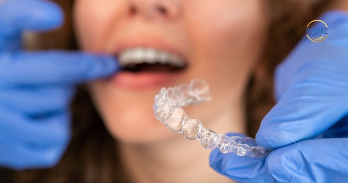 Mãos de dentista usando luvas azuis segurando um alinhador Invisalign em close, mostrando o material transparente e o formato personalizado dos dentes.