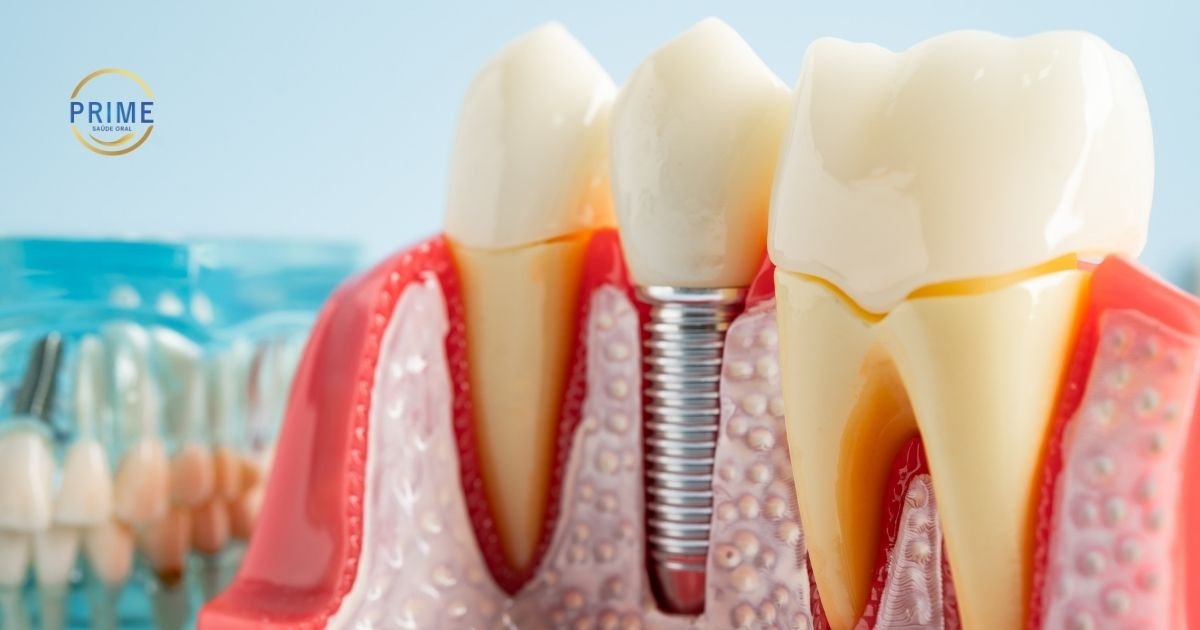 Modelo anatômico comparativo mostrando dentes naturais com raízes e um implante dentário de titânio integrado ao osso da mandíbula.