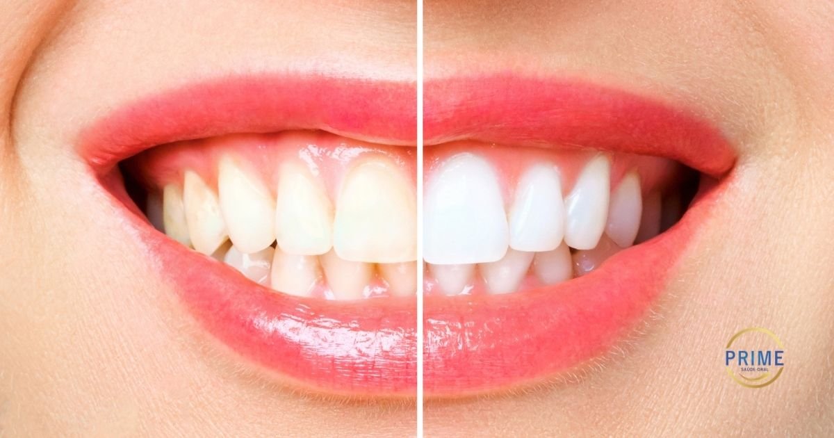Imagem comparativa em divisão vertical mostrando um sorriso com dentes amarelados (lado esquerdo) e o mesmo sorriso com dentes clareados e brancos (lado direito).