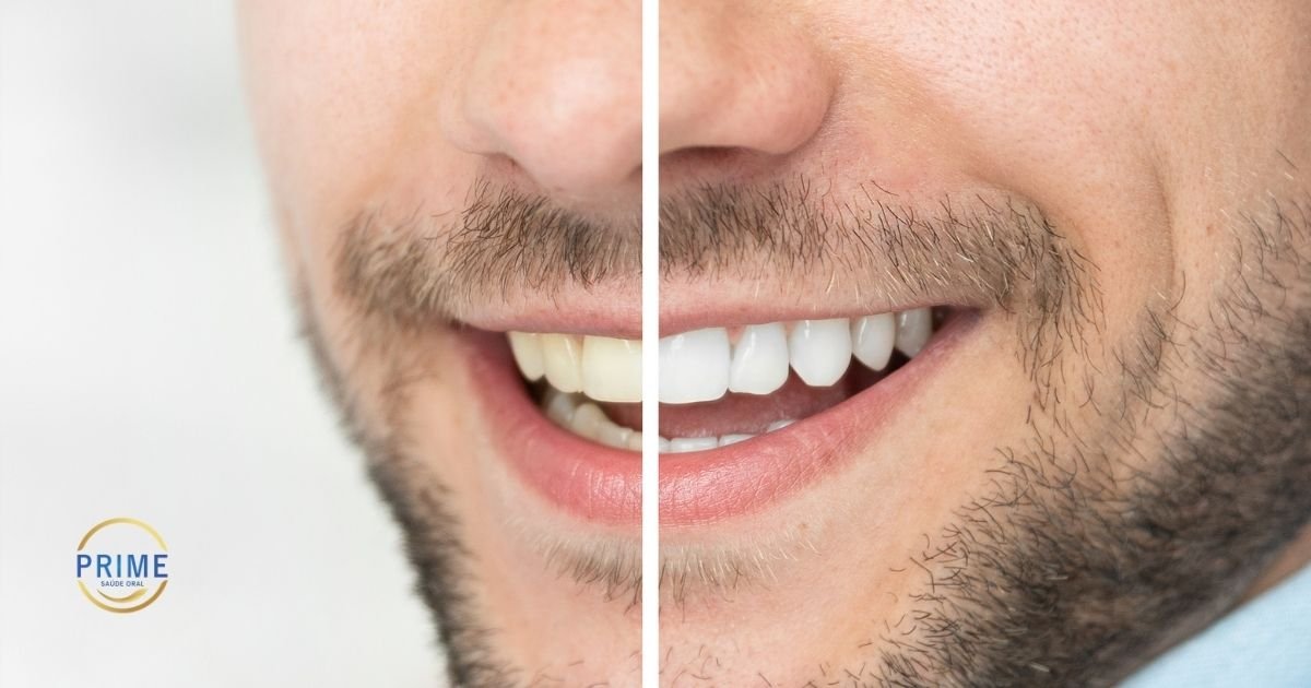 Close-up comparativo do sorriso de um homem com barba. O lado esquerdo mostra dentes amarelados; o lado direito, após a linha de divisão, exibe os mesmos dentes clareados e brancos. O logotipo Prime Saúde Oral está no canto.