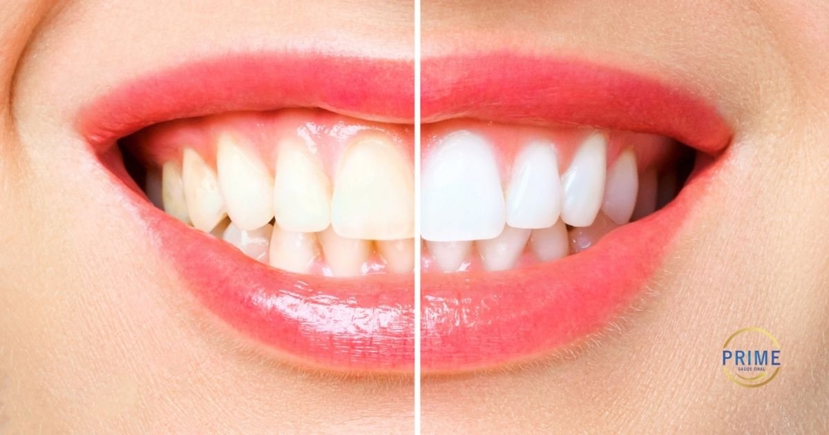 Close-up comparativo de sorriso feminino mostrando dentes amarelados à esquerda e dentes brancos clareados à direita, com logo da Prime Saúde Oral