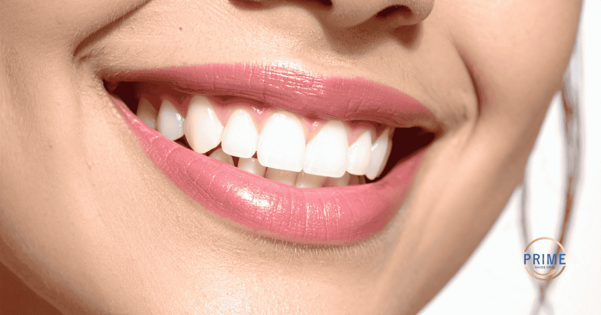 Close do sorriso de uma mulher com dentes brancos e perfeitamente alinhados, representando o resultado das lentes de contato dentais.