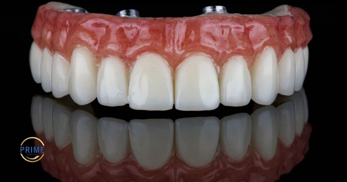 Prótese protocolo com parafusos de implante visíveis na parte superior, mostrando dentes brancos e gengiva em resina rosa, com logo da Prime Saúde Oral