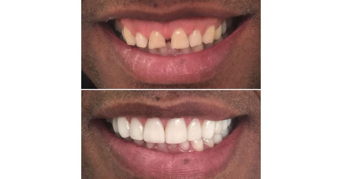 alternativoComparativo antes e depois de sorriso masculino mostrando transformação na cor e formato dos dentes