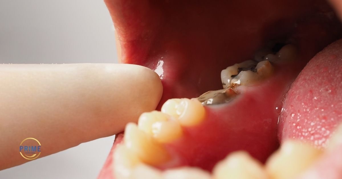 Close intraoral mostrando dentes de leite com cárie avançada e escurecimento severo, com dedo indicando a região afetada, com logo da Prime Saúde Oral