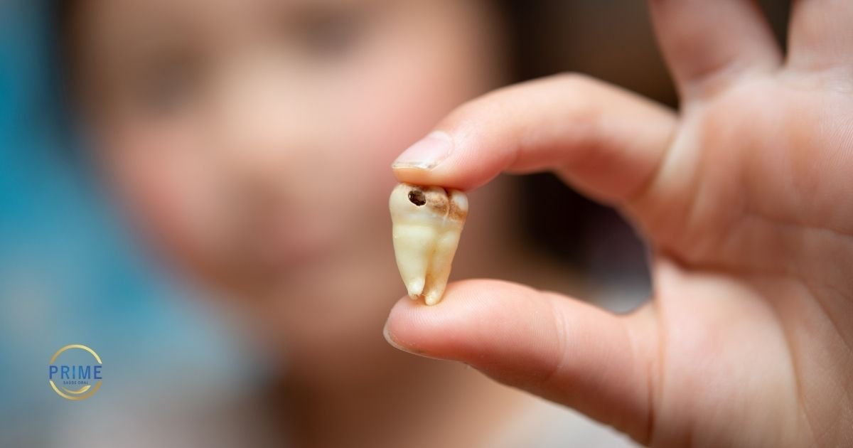 Criança segurando dente de leite extraído com lesão de cárie visível na coroa, com logo da Prime Saúde Oral