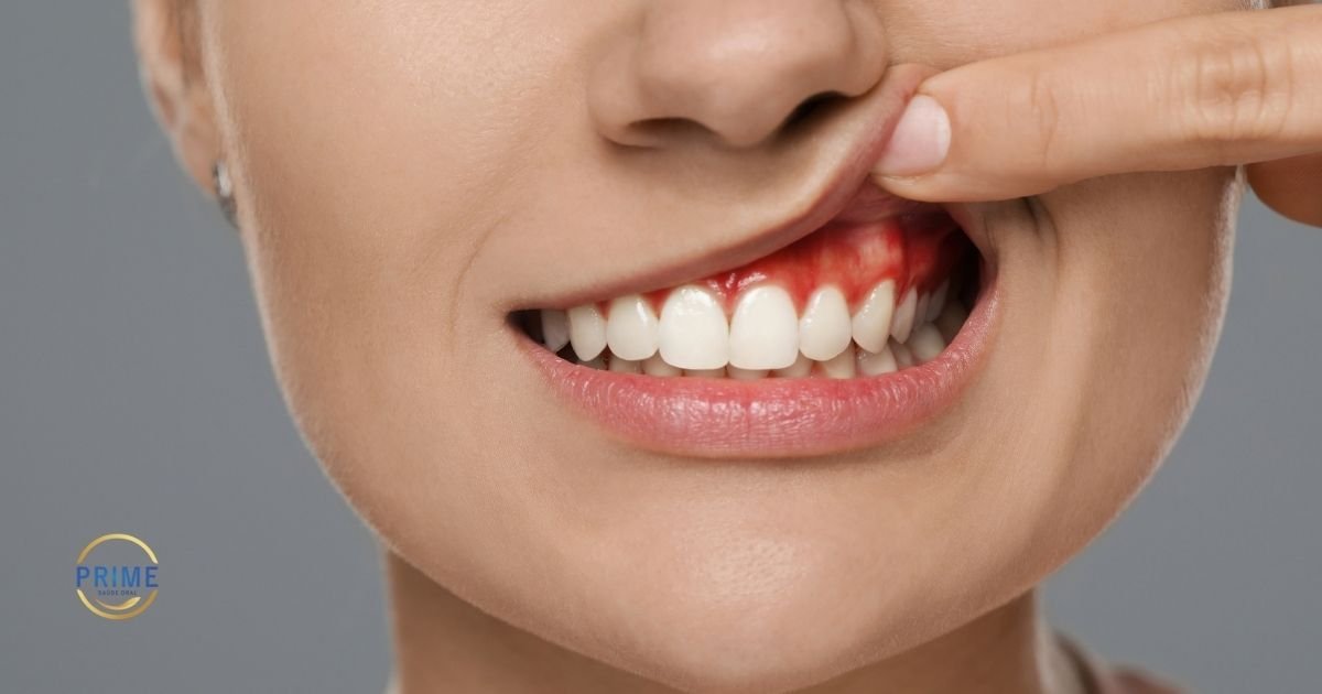 Close-up de sorriso feminino com gengiva avermelhada e sangrando, com dedo afastando o lábio superior para mostrar a inflamação gengival