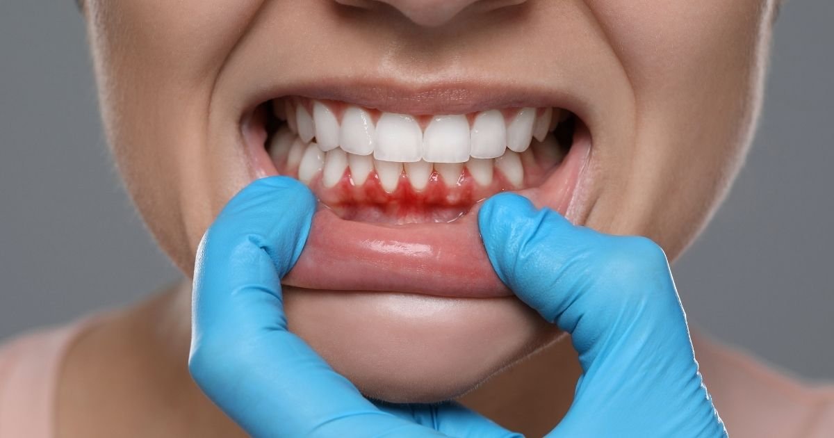 Dentista com luvas azuis afastando o lábio inferior de paciente para examinar gengiva avermelhada e inflamada com sinais de sangramento