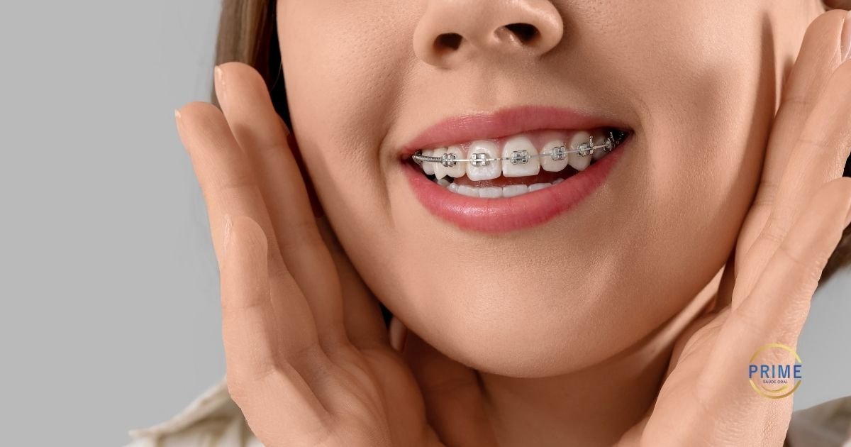 Close lateral de sorriso com aparelho ortodôntico estético de braquetes transparentes nos dentes superiores e inferiores