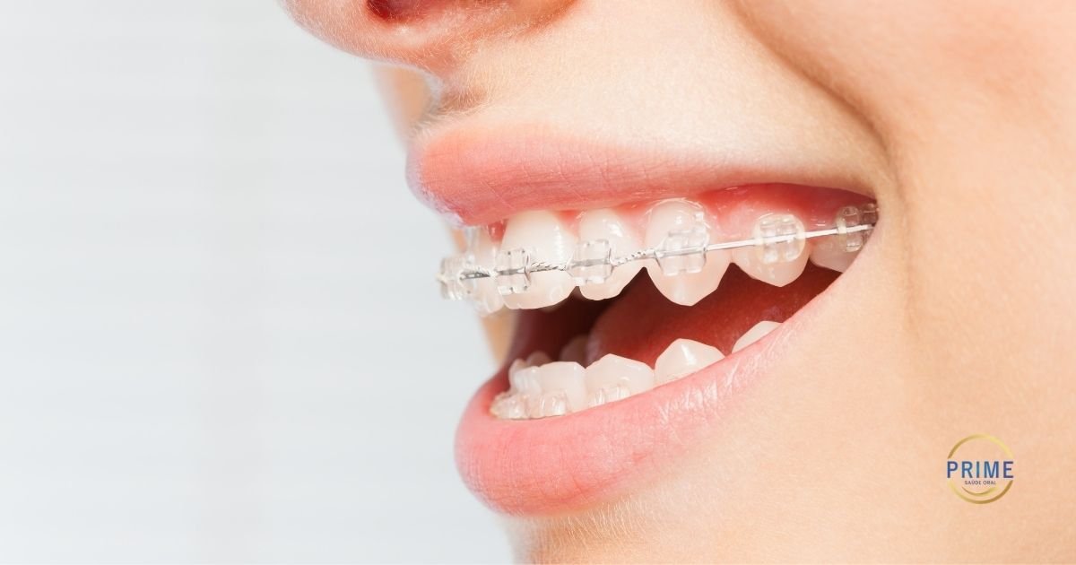 Close de sorriso feminino com aparelho ortodôntico metálico convencional nos dentes superiores e inferiores, com mãos emoldurando o rosto