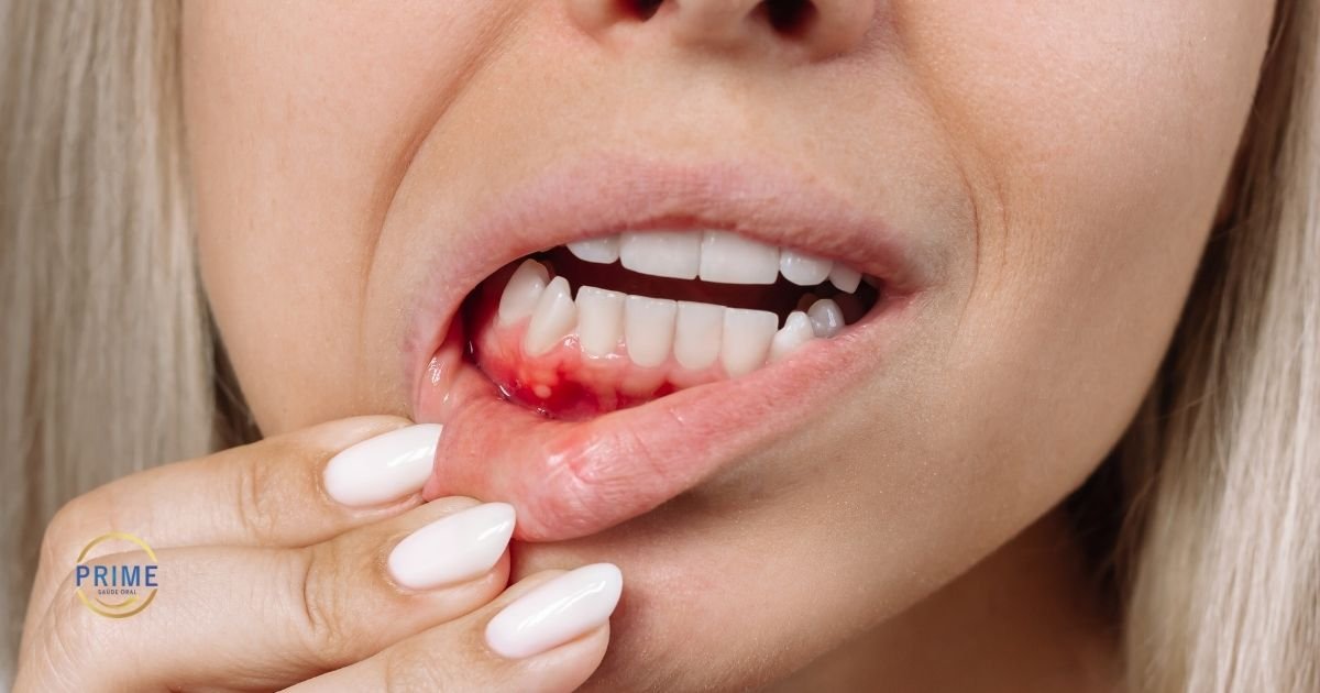 Close de sorriso feminino com gengiva inferior avermelhada e sangrando, com mulher afastando o lábio inferior para mostrar a inflamação, com logo da Prime Saúde Oral