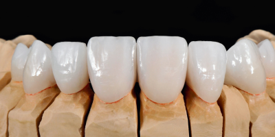 Lentes de contato dental aplicadas em Alphaville na Prime Saúde Oral