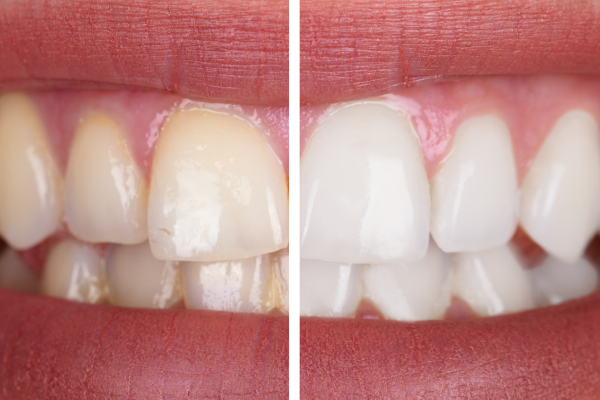 Mulher sorrindo após clareamento dental profissional em Alphaville.