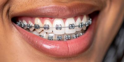 Paciente realizando tratamento ortodôntico com especialista em Alphaville