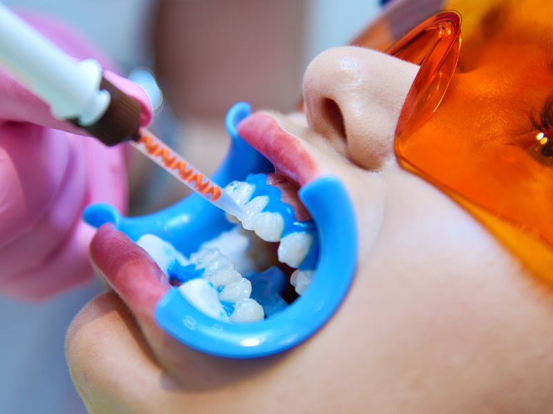 Clareamento dental profissional na Prime Saúde Oral em Alphaville