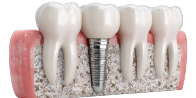 Sorriso renovado com implante dental na Prime Saúde Oral__