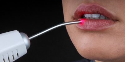Equipamento de Laser moderno utilizado em tratamentos odontológicos na Prime Saúde Oral.