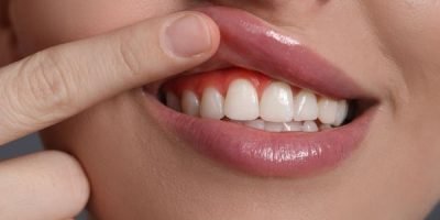 Tratamento periodontal minimamente invasivo com Dra. Vanessa Nani