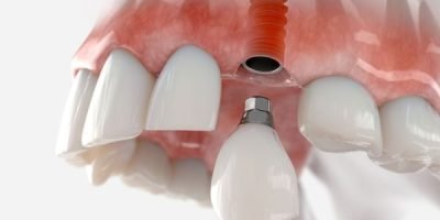 Close de prótese dental estética feita com tecnologia CAD/CAM na Prime Saúde Oral.