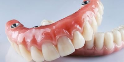 Sorriso renovado após tratamento de carga imediata na Prime Saúde Oral